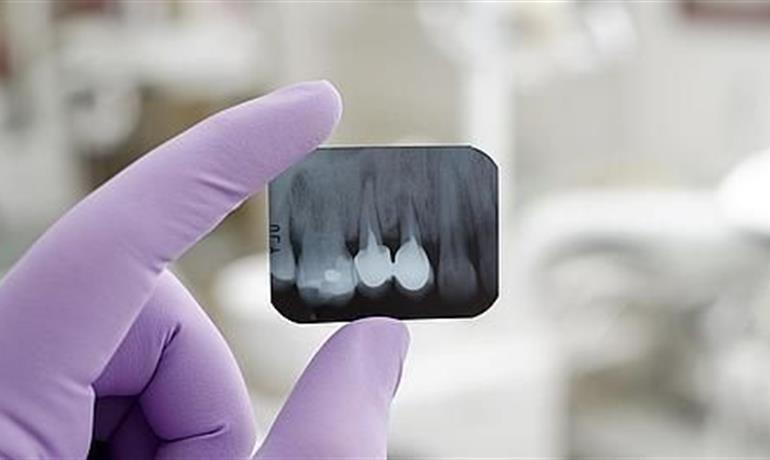 رادیوگرافی‌ دندان (عکس برداری از دندان)